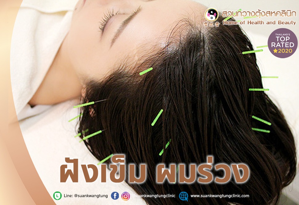 Hair Loss Acupuncture