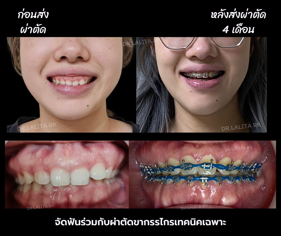 จัดฟันร่วมผ่าตัดขากรรไกร ปรับรูปหน้า แก้คางยื่น  ยิ้มเห็นเหงือกเยอะโดยทันตแพทย์เฉพาะทาง