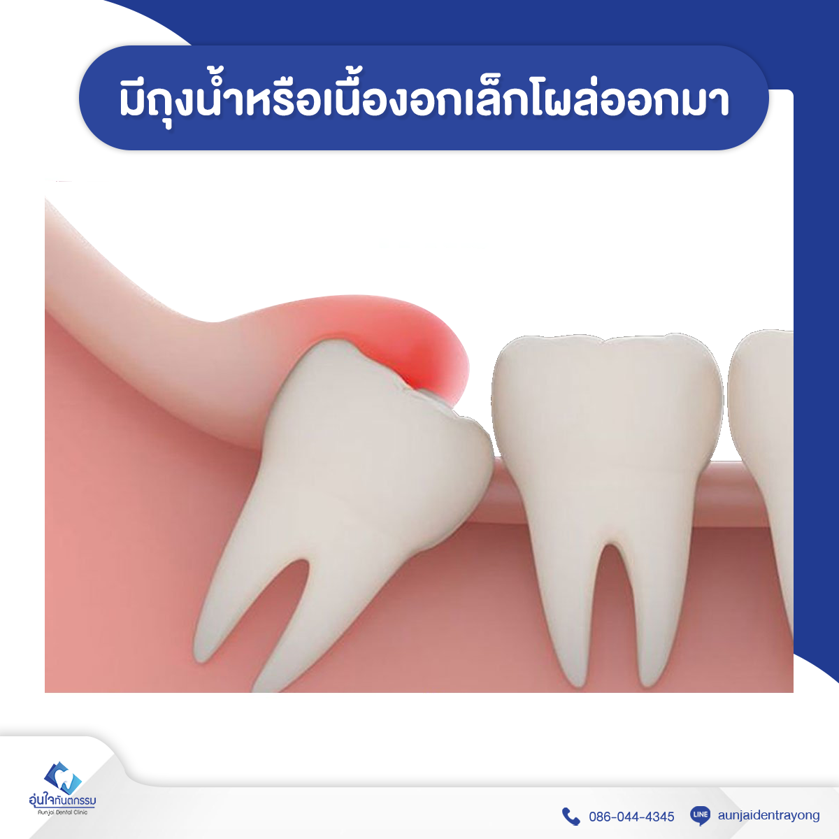 ปวดกรามต้องระวัง!